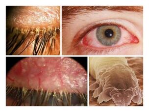 симптоми наявності паразитів під шкірою людини